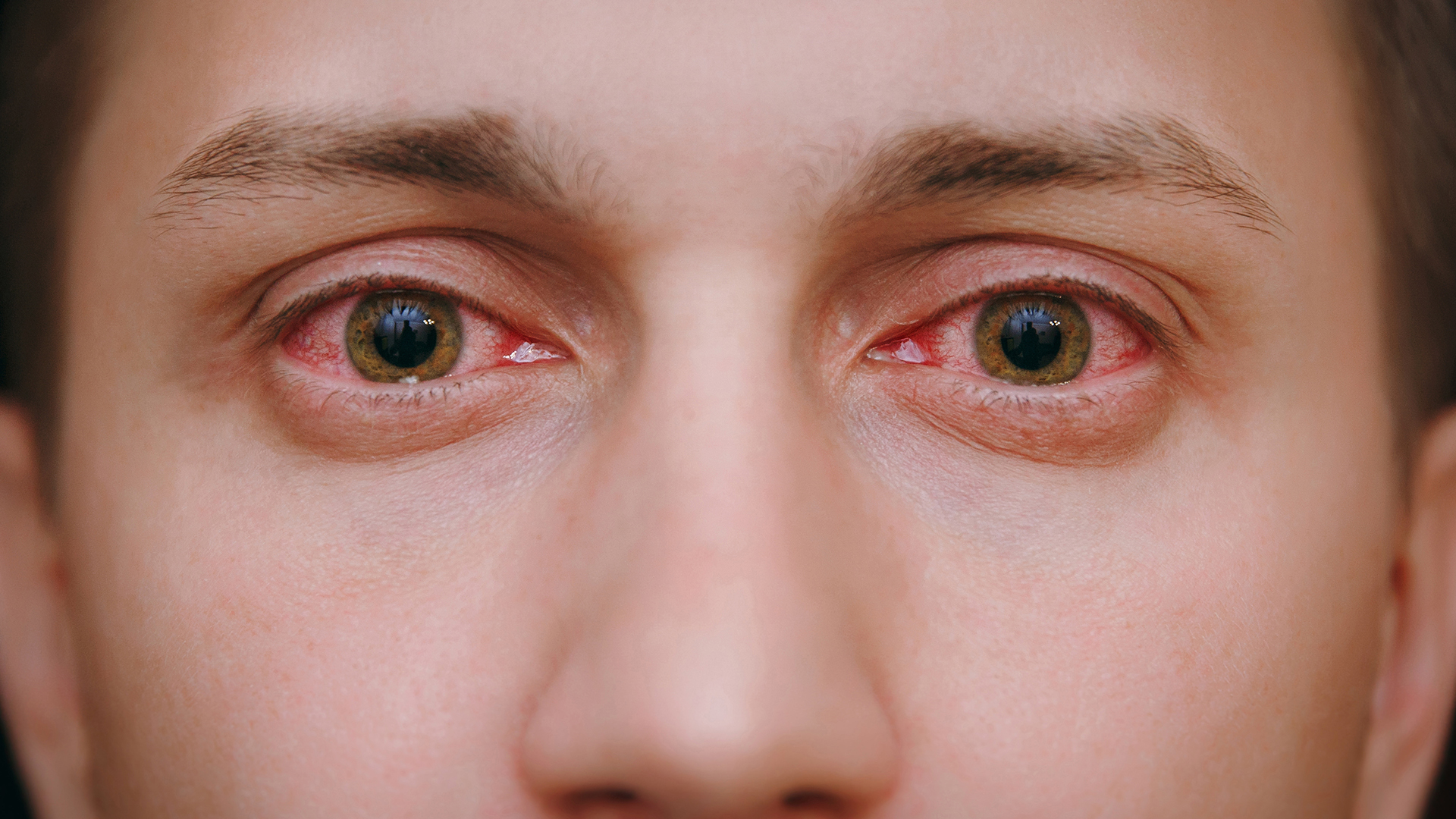 Conjunctivitis