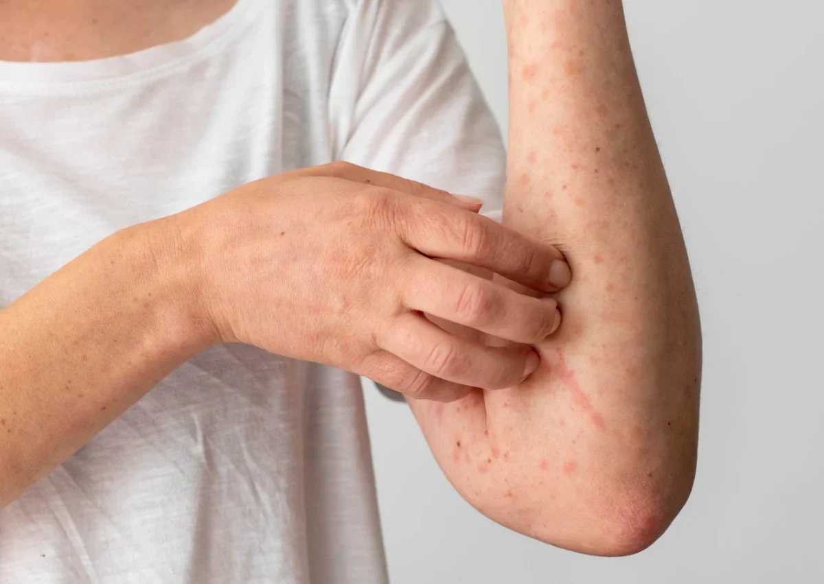 موسم سرما میں الرجی اور خارش کے آسان حل itching-and-allergy-in-winter