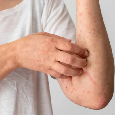 موسم سرما میں الرجی اور خارش کے آسان حل itching-and-allergy-in-winter
