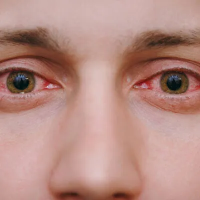 Conjunctivitis